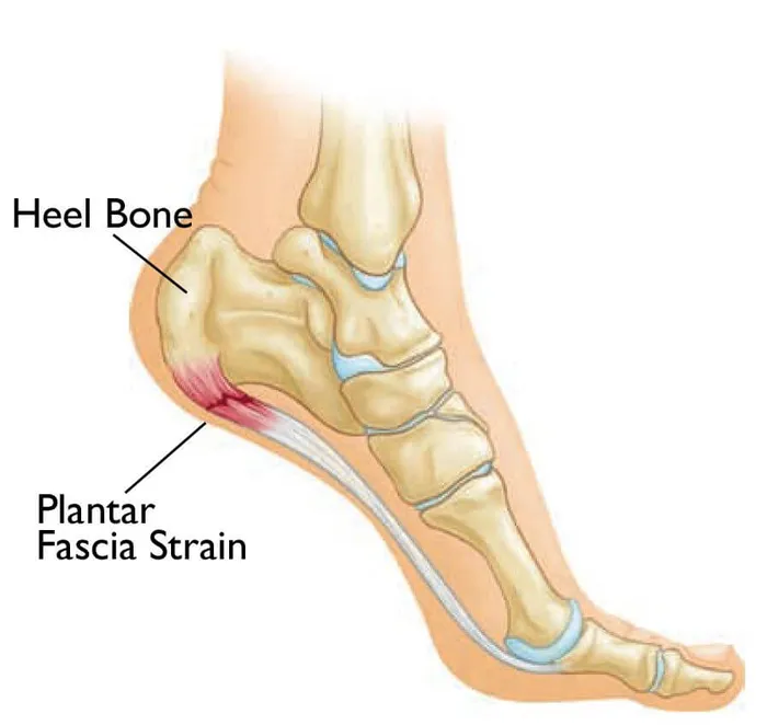 Anatomy diagram of plantar fascia strain at the heel bone